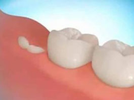 Новейшая технология позволит выращивать собственные зубы всего за 9 недель!