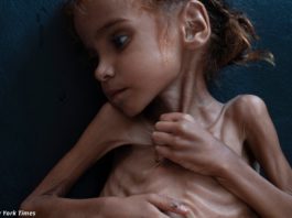 Умерла 7-летняя девочка, ставшая символом голода на богатом Ближнем Востоке