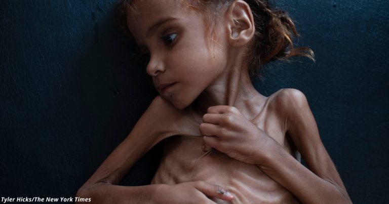 Умерла 7-летняя девочка, ставшая символом голода на богатом Ближнем Востоке