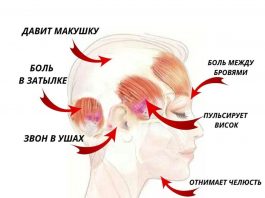 Карта головной боли и их лечение. Не потеряйте эту шпаргалку