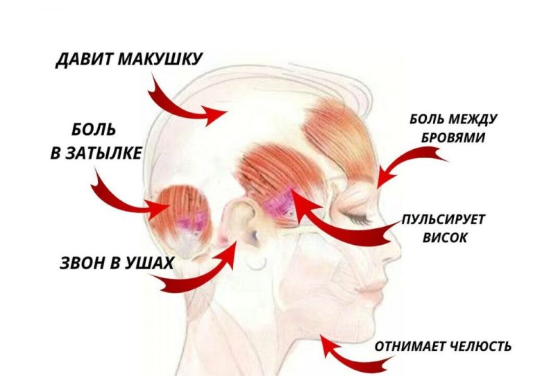 Карта головной боли и их лечение. Не потеряйте эту шпаргалку