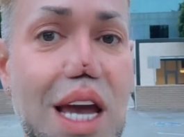 Друг Солнцева рассказал, что случилось с его носом: “Я не могу смотреть на себя в зеркало”