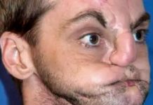 Человек без лица, которому вернули новую жизнь: невероятное преображение Ричарда Норриса потрясло мир