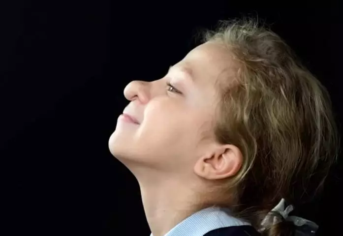 “Она стеснялась очень”. 11-летней Варе сделали операцию по коррекции носа